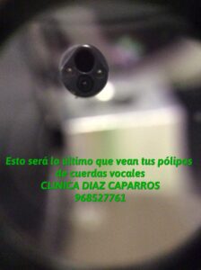 ¿En qué consiste el tratamiento mediante endoscopio flexible a través de la nariz? · Clínica Díaz Caparrós