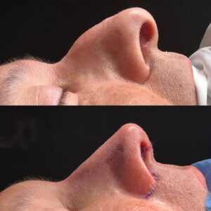 Rinoplastia