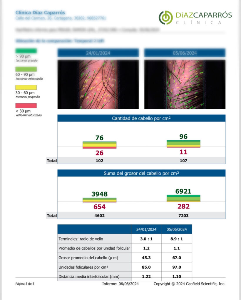 Resultado Hirmetrix