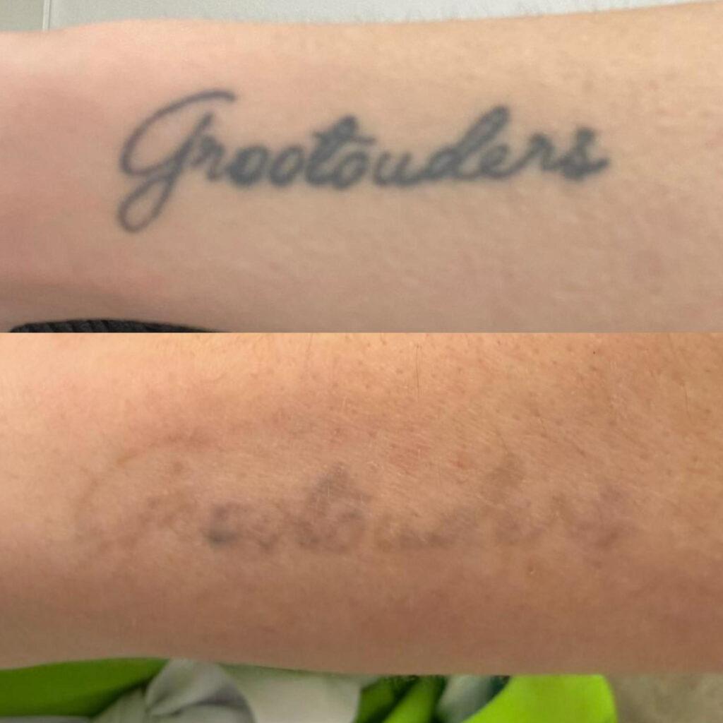 Eliminación de tatuajes