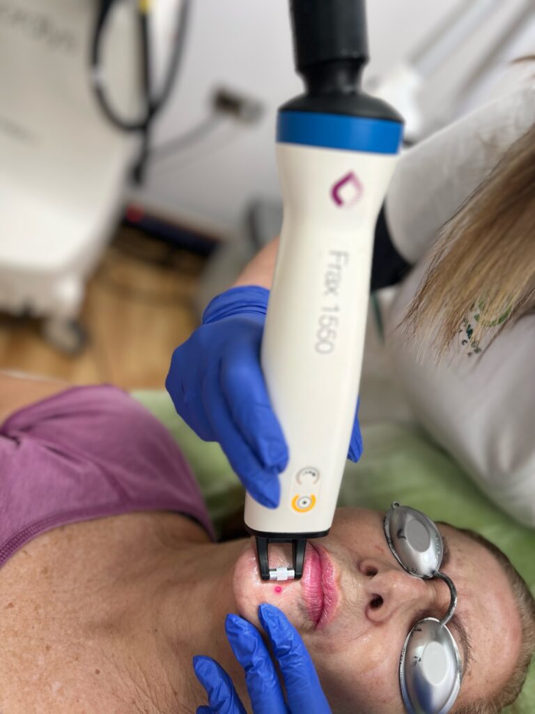 Eliminar Manchas con laser